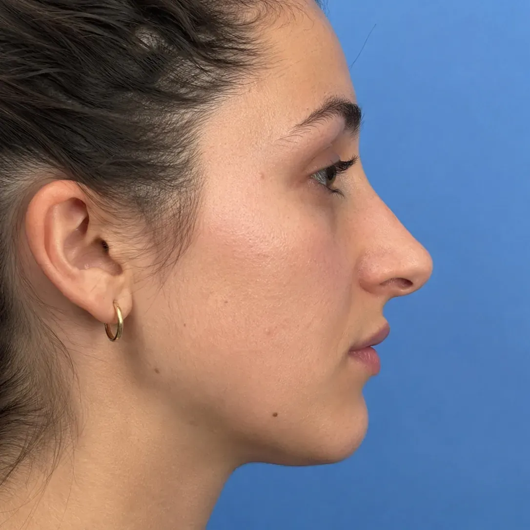Simulation of a rhinoplasty in profile