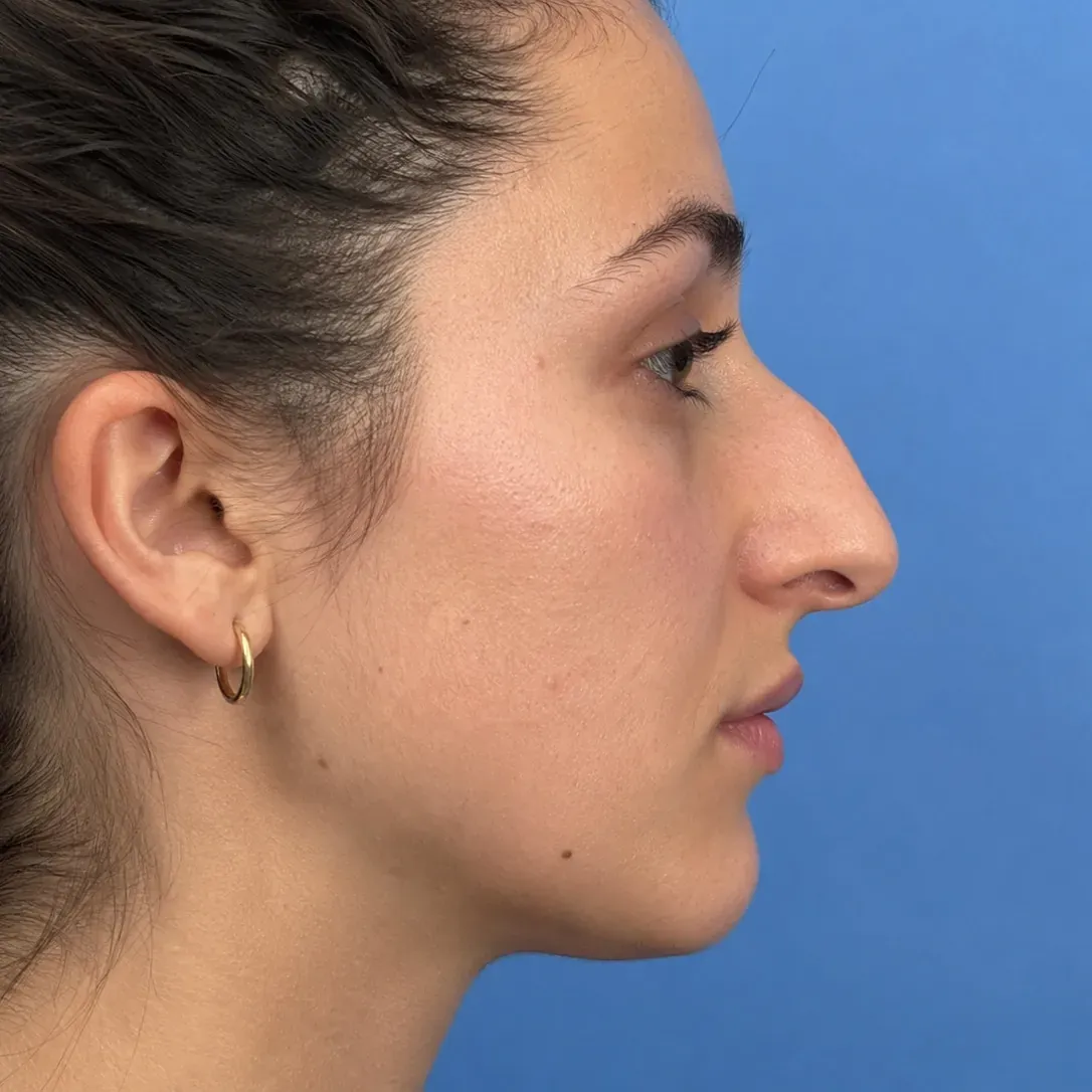 Original patient photograph in profile