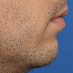 Original chin profile
