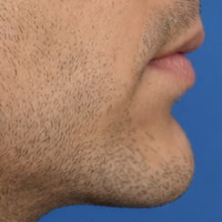 Same chin after the Push brush
