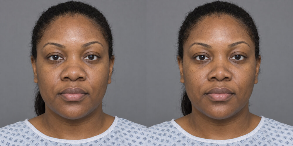 Ethnic rhinoplasty simulated with Plastic Surgery Simulator