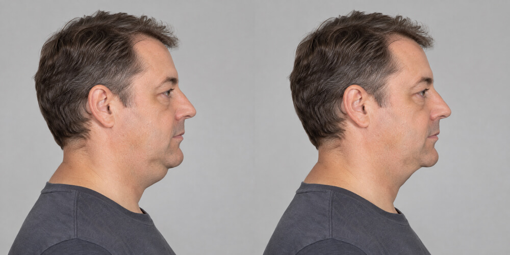 Double chin removal simulated with the Plastic Surgery Simulator
