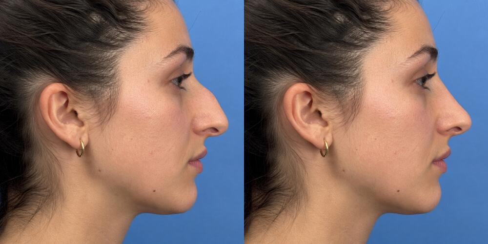Rhinoplasty simulated with Plastic Surgery Simulator