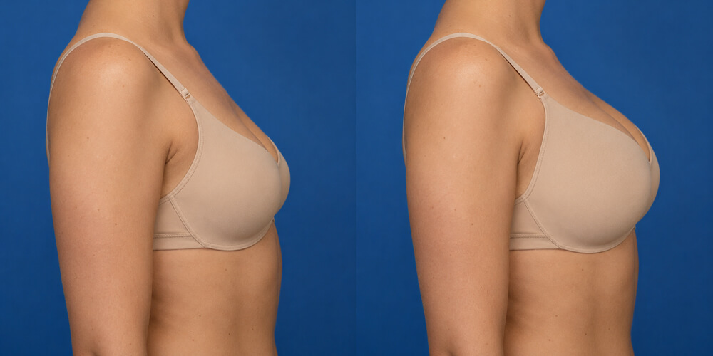 Breast augmentation simulated with Plastic Surgery Simulator