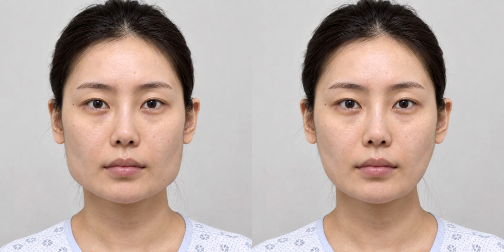 Face contouring - Jaw reduction — Before / After
